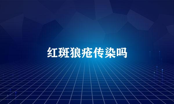 红斑狼疮传染吗