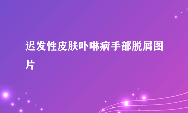 迟发性皮肤卟啉病手部脱屑图片