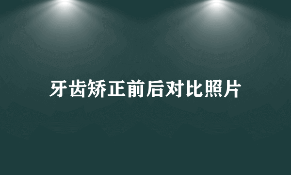 牙齿矫正前后对比照片