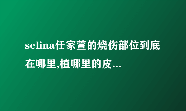 selina任家萱的烧伤部位到底在哪里,植哪里的皮为什么要剪头发？