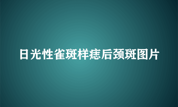 日光性雀斑样痣后颈斑图片